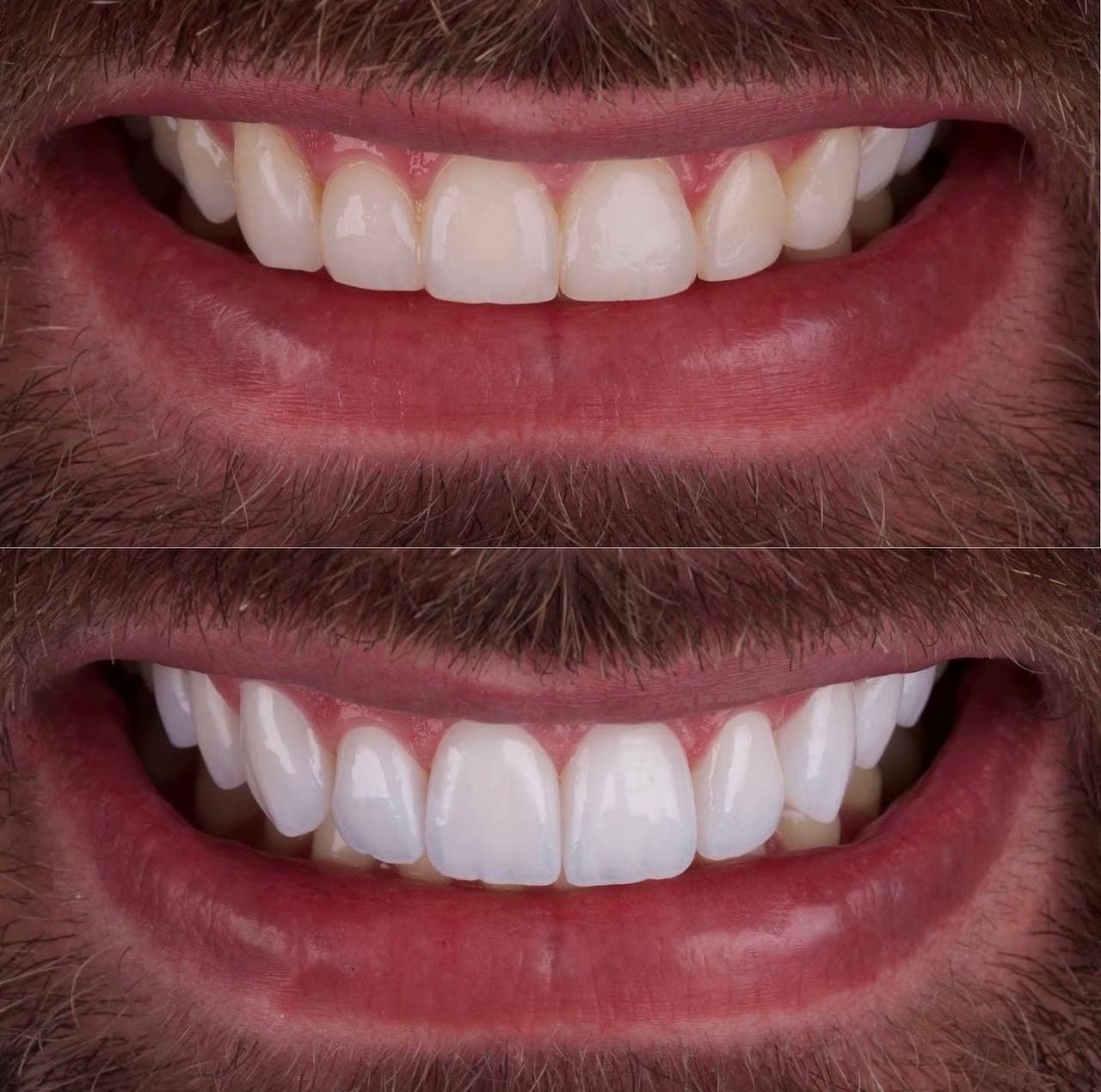Hollywood Smile