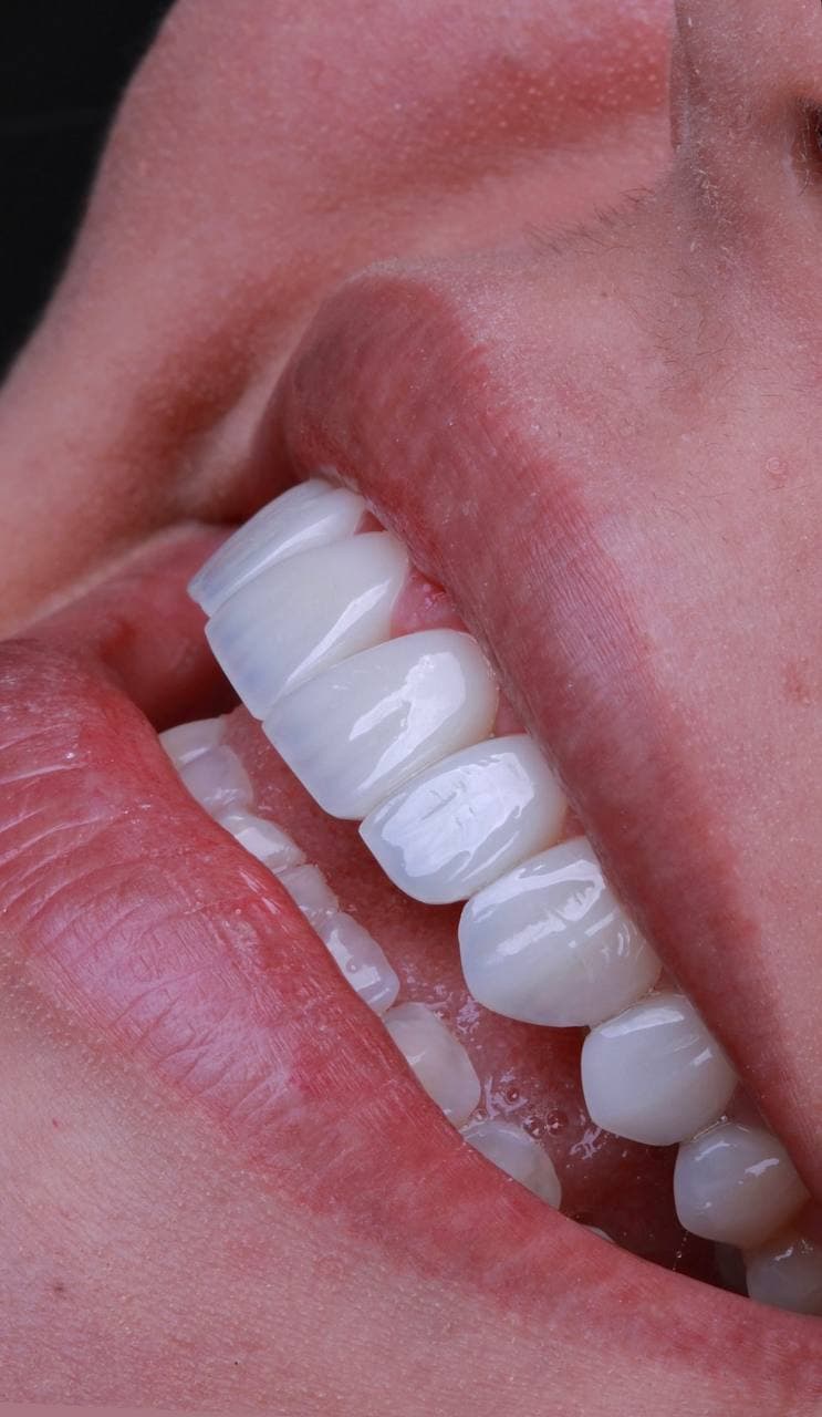 Zirconium Crowns